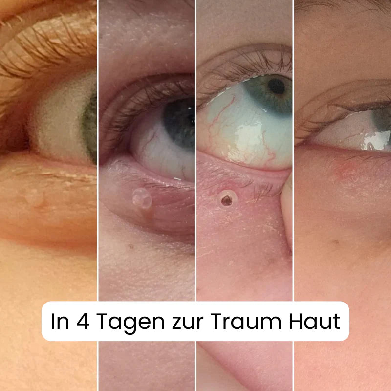 TagBuddy Kit – Keine Hautanhängsel mehr